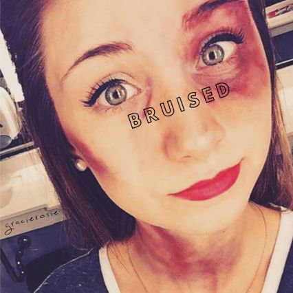 bruised.jpg